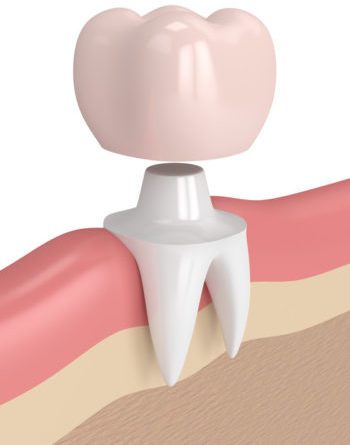 Dental Bridges & Crowns Arizona Dental Bridges & Crowns Arizona