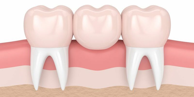 Dental Bridges & Crowns Arizona