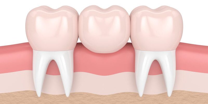 Dental Bridges & Crowns Arizona